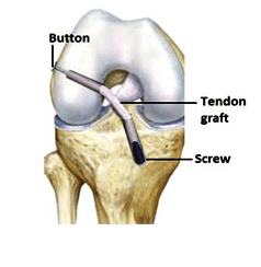 ACL Traditional orthospecialist bangalore