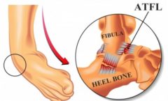 ATFL injury surgery orthospecialist bangalore