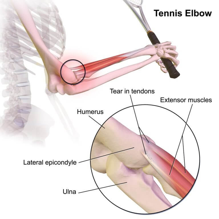 Tennis_Elbow treatment bangalore