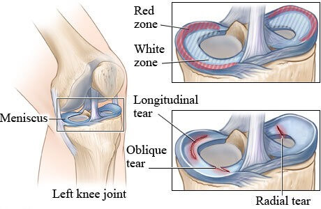 knee meniscus tear orthospecialist bangalore