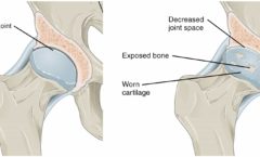 Hip Osteoarthritis treatment orthospecialist bangalore