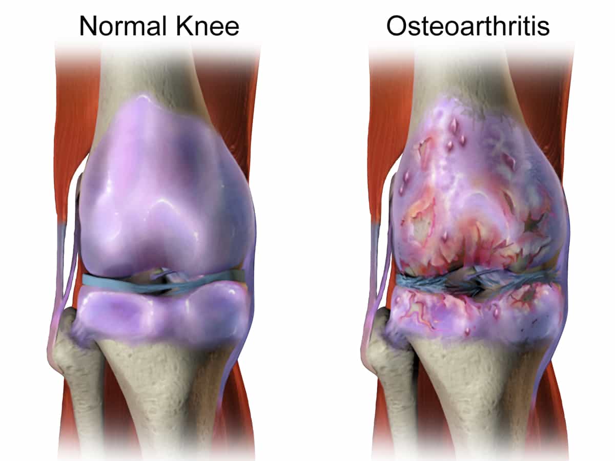 Knee Arthritis orthospecialist bangalore