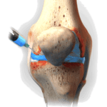 prp-therapy-orthospecialist bangalore